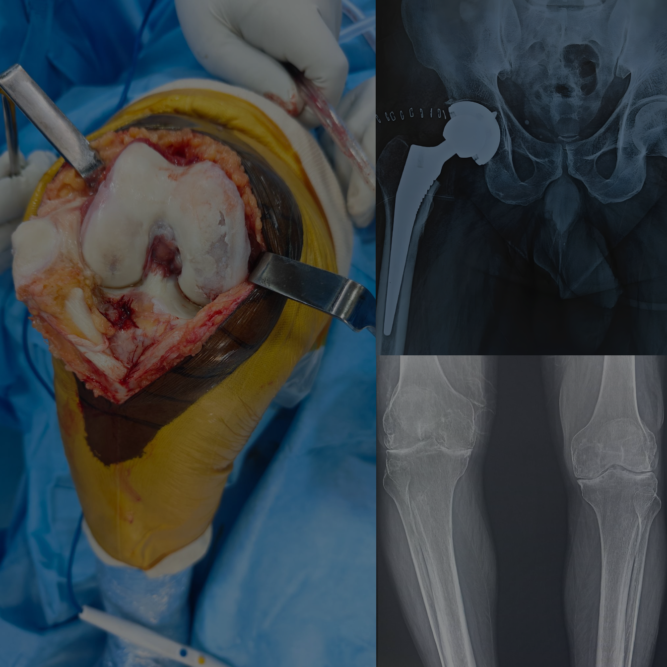 Joint Replacement Surgery